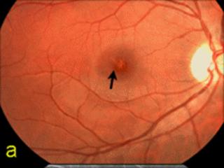 Photo showing the patient's eye damage