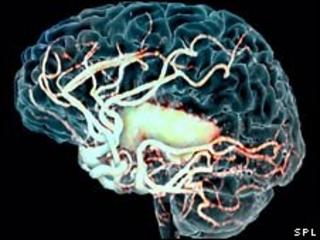 Brain scan after a stroke