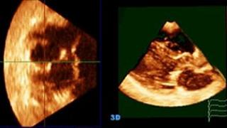A screen image of multiplane review (MPR) 3D echocardiography