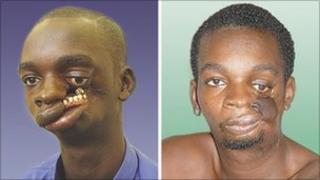 John Bortey before and after his surgery