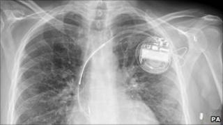X-ray of Mr Nixon's chest