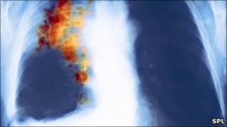 Lung cancer