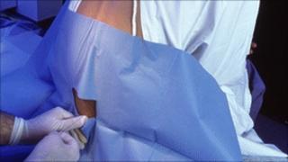 epidural