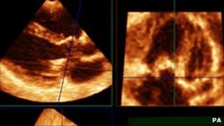 Patient heart scan