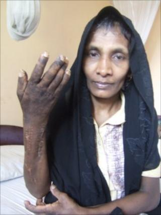 Шри-ланкийский домашний работник показывает ее руку, которая, по ее словам, была повреждена ее работодателями (фото предоставлено: Dushiyanthini Kanagasabapathipillai / Human Rights Watch)