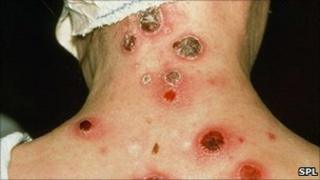 Syphilis