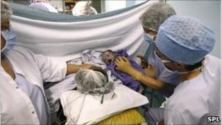 Caesarean