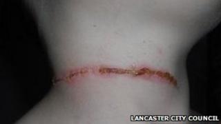 Isaac Hargreaves' scar