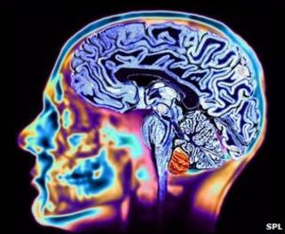 MRI scan of a brain