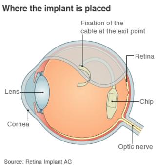 Images Two blind British men have electronic retinas fitted - BBC News 2 Images Two blind British men have electronic retinas fitted - BBC News 2