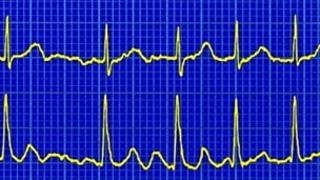 Atrial fibrillation on a heart trace called an ECG
