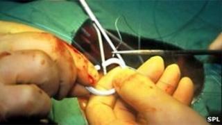 Heart valve surgery