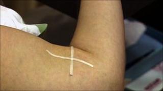 Contraceptive device being inserted
