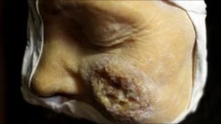 A wax cast of a STI sufferer on display in a private medical museum in Paris