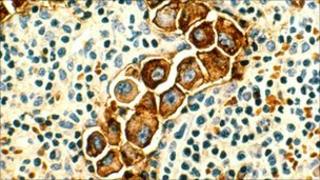 Lymph node showing cancer cells