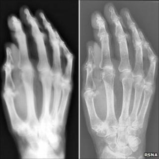 Side-by-side X-ray images of a hand (courtesy RSNA)