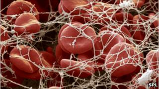 A blood clot