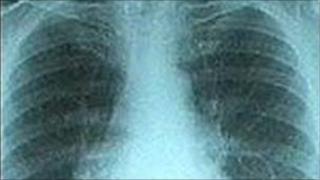 X-ray of chest
