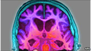 MRI Brain scan