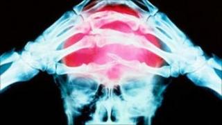 X-ray graphic showing a headache