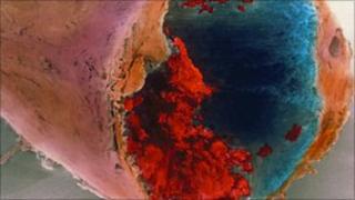 Blood clot in a coronary artery
