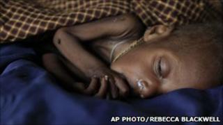 A young Somali child being treated for severe malnutrition