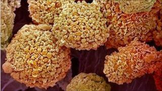 breast cancer cells