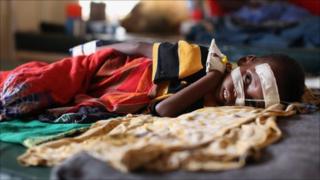 A young boy rests on a hospital bed in a paediatric ward adjacent to the Ifo refugee camp which makes up part of the giant Dadaab refugee settlement on July 19, 2011 in Dadaab, Kenya