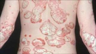 Psoriasis on back of patient