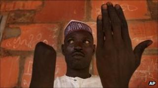 A man shows his amputated hand (archive shot)