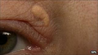 Yellow plaque on the eyelid
