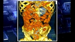 Digital image of cocaien capsules inside the body of the alleged smuggler