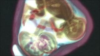 Twin pregnancy at 32 weeks