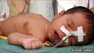 Файл с фотографией ребенка, страдающего вирусным энцефалитом, в больнице в Горакхпуре