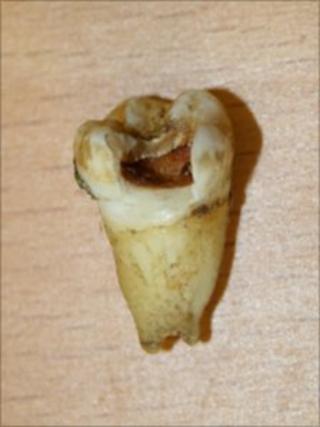 John Lennon's tooth