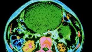 A scan of an ovarian tumour (in green)