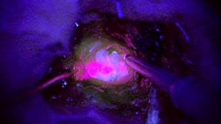 Glowing tumour