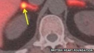 PET-CT scan of adrenals