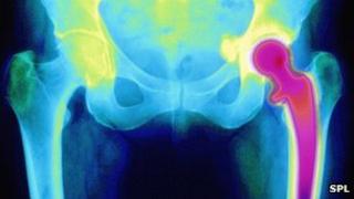 Hip replacement