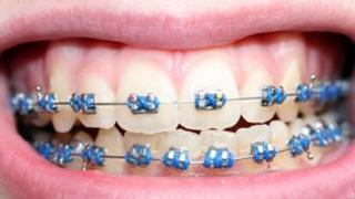 Braces on teeth