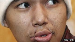 A prisoner on hunger strike has his mouth sewn with wire at a prison in the Kyrgyz capital Bishkek on Tuesday
