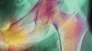 Hip fracture
