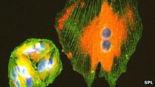 Melanoma cancer cells