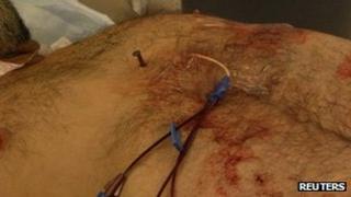 A nail is shown in the chest of of Dennis Hennis 6 April 2012