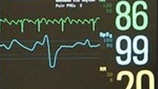 ECG