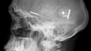 Рентген черепа, показывающий положение чипа с кабелем, идущим к блоку управления