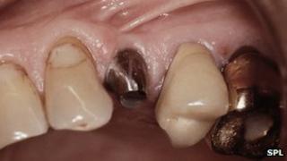 Upper jaw of a patient showing the position of an implant (centre) on which an artificial tooth is placed