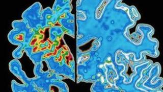 Здоровый мозг и мозг Альцгеймера
