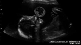 Baby scan pic