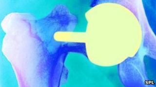 Hip resurfacing